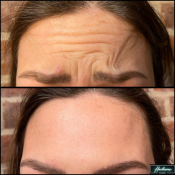 Anti-wrinkle injection treatment