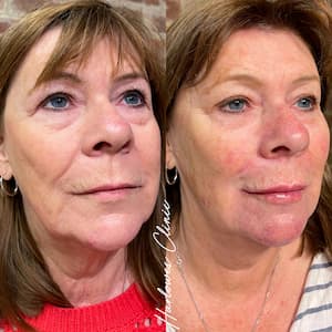 cheek dermal fillers