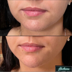 chin dermal filler treatment