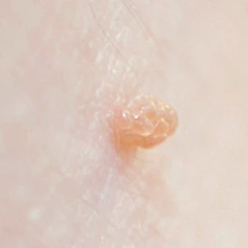 Cryotherapy Treatments