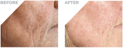 Dermaforce treatments