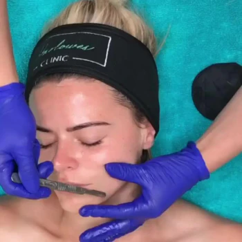 Dermaplaning Treatment