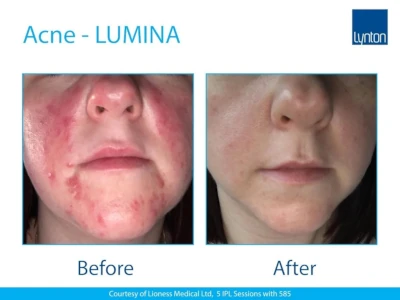 Acen Lumina