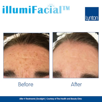 Illuminfacial