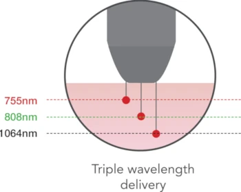 Laser Hair Removal - Triple wavelength delivery