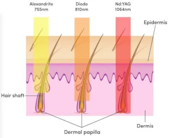 Laser Hair Removal - wavelengths