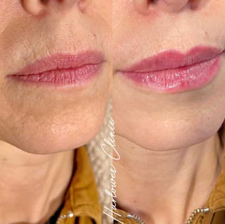 lips and dermal fillers
