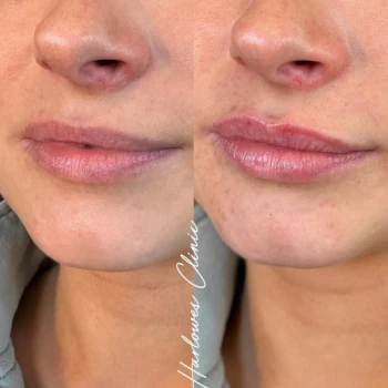 Lip and Dermal Fillers