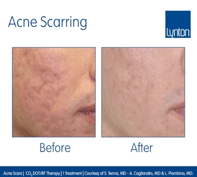 Lynton Resurface reduces acne scaring