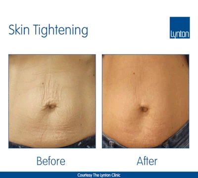 Lynton resurface - improves skin firmness and elasticity