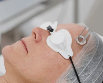 Fractional Laser Resurfacing