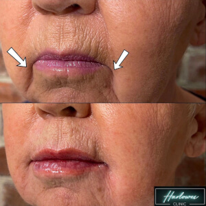 nasolabial folds and marionette lines