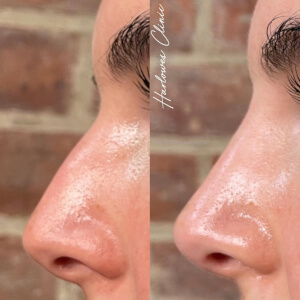 rhinoplasty dermal filler treatment