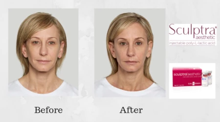 sculptra treatment example