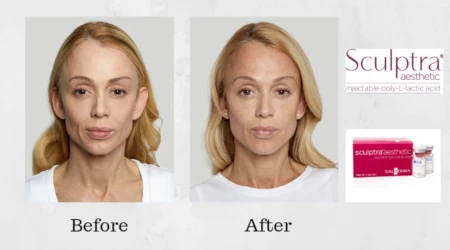 Sculptra Treatments