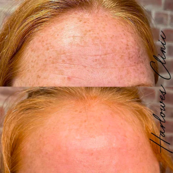 Skin Booster treaments