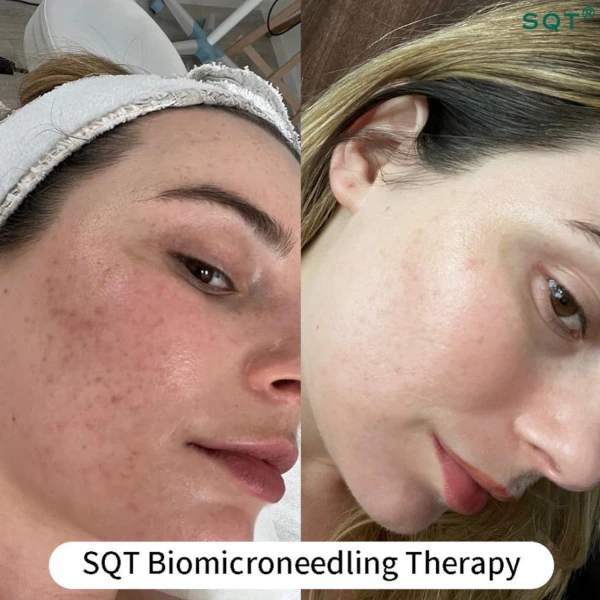 SQT Bio Microneedling - Sophie Rae, Kent