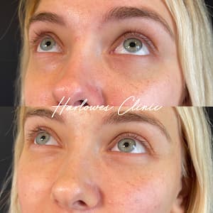 cheek dermal fillers