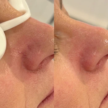 Dermaforce treatments